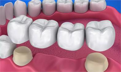 Diş köprüsü zararları nelerdir
